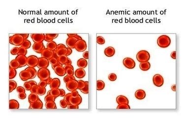 Anemia Red Blood Cells Image - Graph Diagram