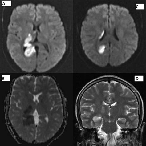 Anterior choroidal artery infarction | BMJ Case Reports