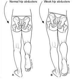 Trendelenburg Test - Pediatric Hip Pain