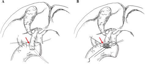 Schematic illustration of two different anastomotic methods in Group A... | Download Scientific ...