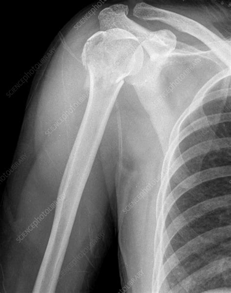 Humerus fracture, X-ray - Stock Image - F036/0229 - Science Photo Library