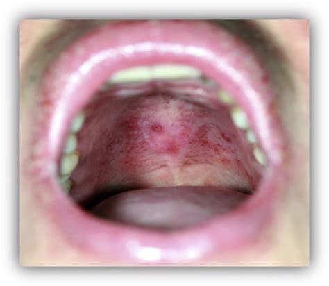 Lamotrigine-induced DRESS with purpuric lesions in the oral mucosa - JAAD Case Reports