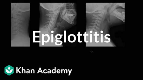 Epiglottitis diagnosis and treatment | Respiratory system diseases | NCLEX-RN | Khan Academy ...