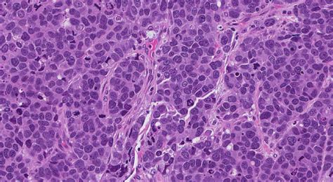 Large cell neuroendocrine carcinoma of the lung | MyPathologyReport.ca