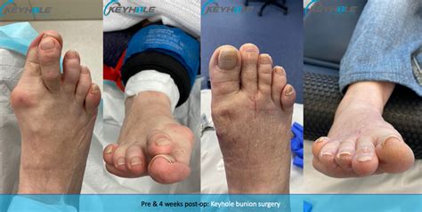 Bunion Surgery Perth - Foot Surgeon Perth | Perth Podiatric Surgery