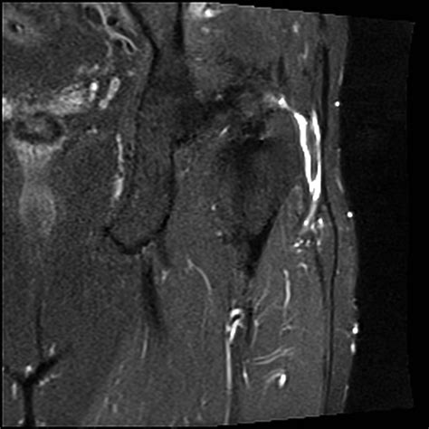 Bursitis MRI - wikidoc