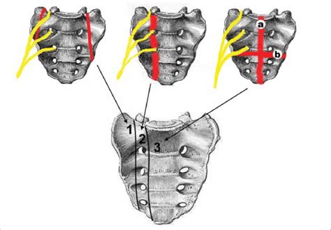 Classification of sacral fractures (4). | Download Scientific Diagram