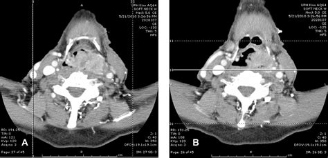 FULL TEXT - SIADH as a paraneoplastic syndrome of squamous cell carcinoma of the hypopharynx ...