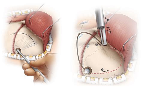 Craniotomy | Expert Surgeon | Aaron Cohen-Gadol MD