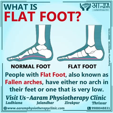 FLAT FOOT- Definition, Symptoms, Causes & Rehabilitation Exercises