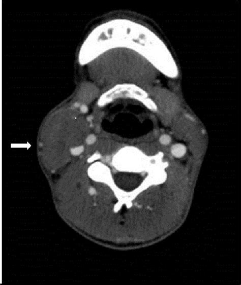 A contrast CT scan at the level of the bifurcation of the right common ...