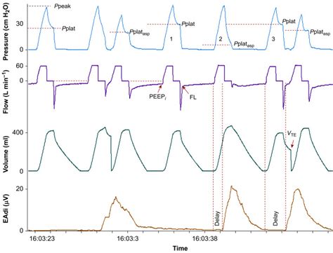 Ventilation of denervated transplanted lung at risk for overdistention by reverse triggering and ...