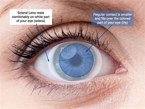 Scleral Contact Lenses | Focal Pointe Eye Care