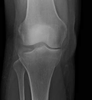 Anterior Tibial Plateau Fracture