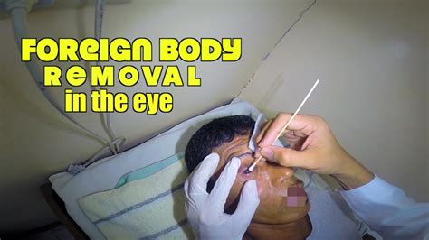 Foreign Body removal in the eye - YouTube