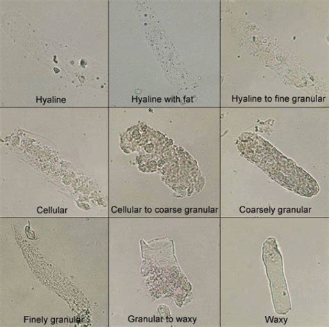 Casts in Urine | Medical Laboratories