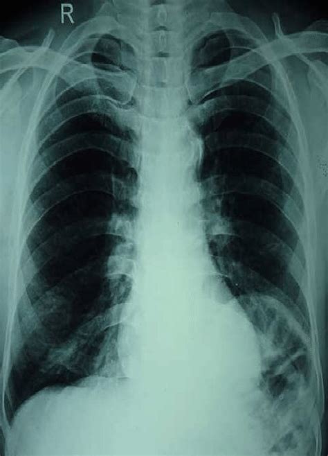 X-ray chest showing elevated left dome of diaphragm | Download Scientific Diagram