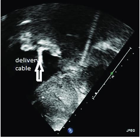 Using transthoracic echo during the procedure, subcostal view showing ...