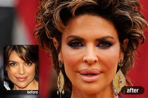 Lisa Rinna before and after lip fillers | Bad celebrity plastic surgery ...