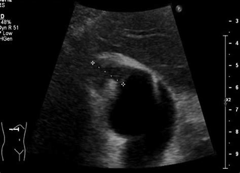 Abdominal ultrasonography also showed localized wall thickening of ...