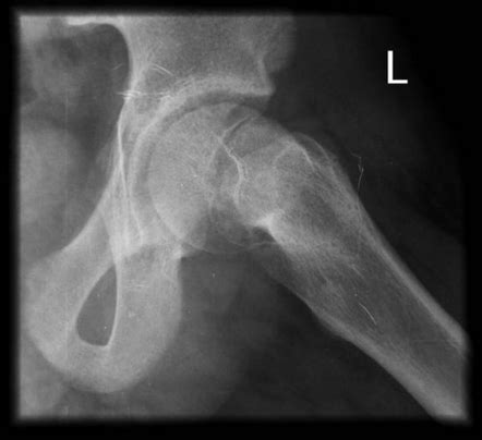 Slipped upper femoral epiphysis | Image | Radiopaedia.org