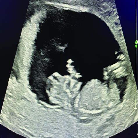 Fetal anencephaly. Ultrasound encephalic deficit depiction. | Download ...