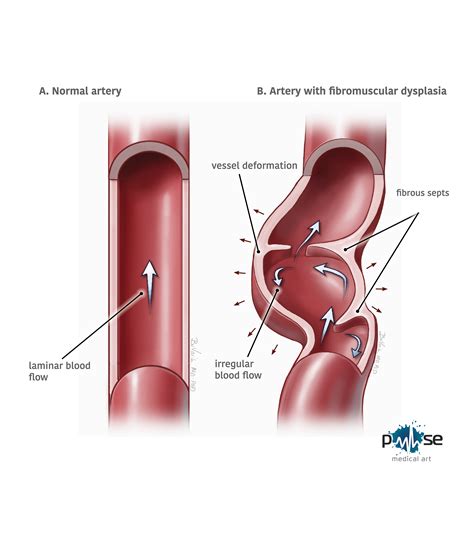 Medical Illustration: Fibromuscular Dysplasia on Behance