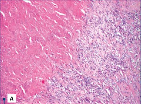 ,5. Histopathology of necrotizing granuloma (lung and pleural biopsies)... | Download Scientific ...