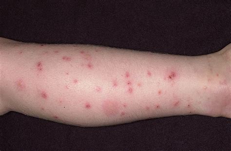 Flea Bites on Humans - Pictures, Symptoms and Treatment