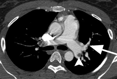 MR Imaging of Pulmonary Embolism: Diagnostic Accuracy of Contrast ...