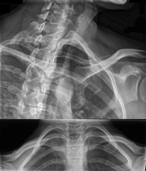 Instability of the sternoclavicular joint | Bone & Joint