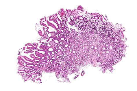 File:Reactive gastropathy - low mag.jpg - Libre Pathology