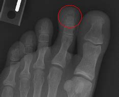 Toe (Phalangeal) Fracture - Ankle, Foot and Orthotic Centre