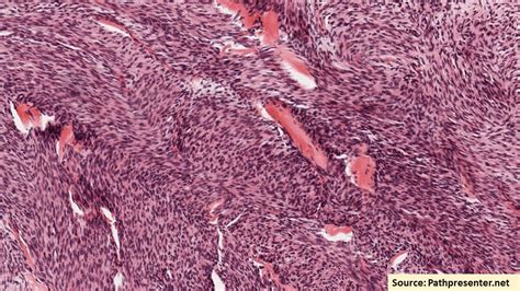 Fibrosarcoma Histology