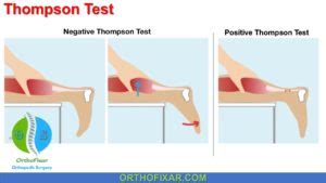 Thompson Test • Easy Explained | OrthoFixar 2024