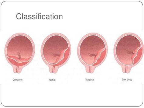 Antepartum haemorrhage