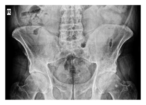 Pelvic X-ray showing bilateral grade III-IV sacroiliitis. | Download Scientific Diagram