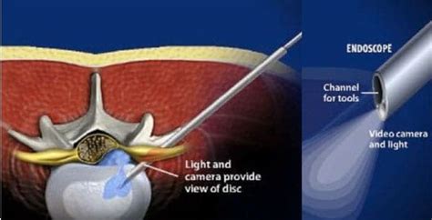 Endoscopic Discectomy - Spinomax