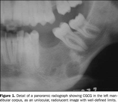 Radiologia Brasileira - Radiological and epidemiological aspects of central giant cell granuloma ...