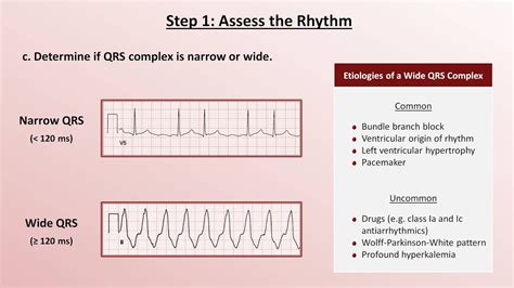 How To Read Ecg Easily - Lori Sheffield's Reading Worksheets