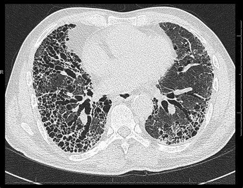 Interstitial Lung Disease Honeycombing