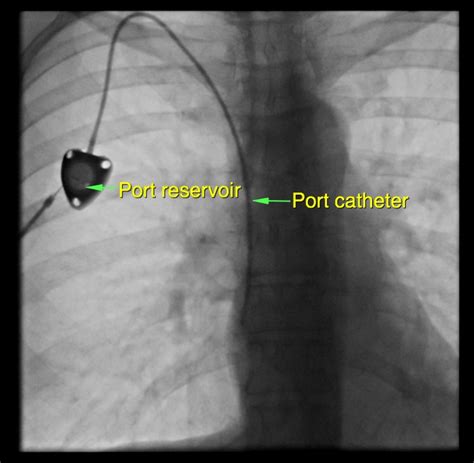 Chemotherapy access (port insertion and removal) - Dr. Eileen Morrisroe