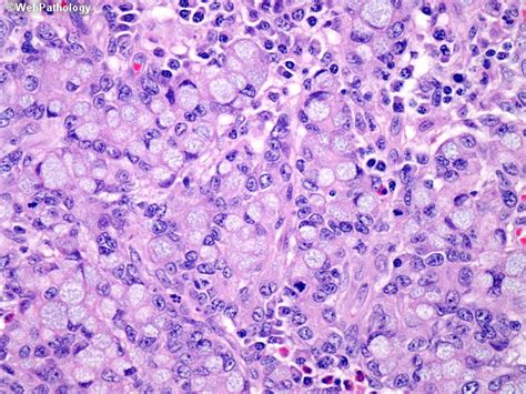 Webpathology.com: A Collection of Surgical Pathology Images