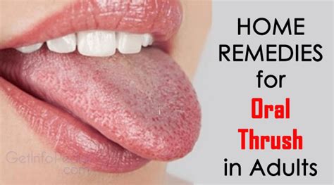 Home Remedies for Oral Thrush in Adults - Get Complete Information