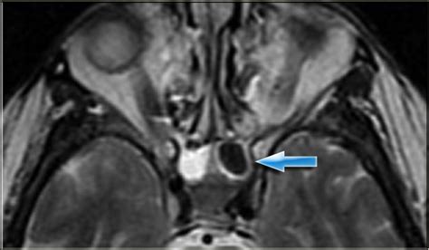 The Radiology Assistant : Paranasal Sinuses - MRI