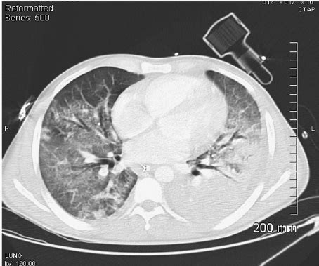 Chest CT scan showing alveolar infiltrations in right lower lobe and... | Download Scientific ...