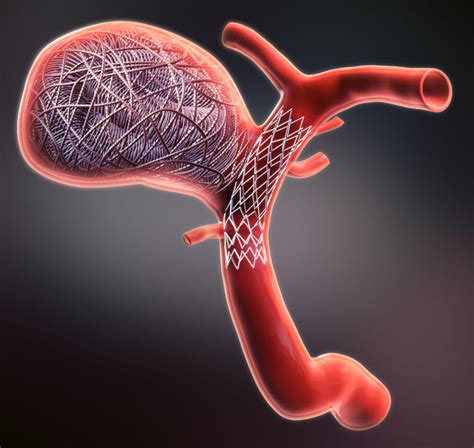 Brain Aneurysm | Barrow Neurological Institute