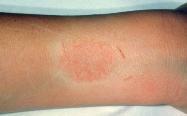 red rash on elbow - pictures, photos