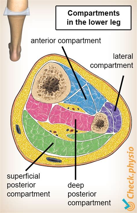 Compartment syndrome of the lower leg | Physio Check