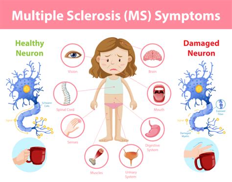 The Relationship Between Multiple Sclerosis and Anxiety